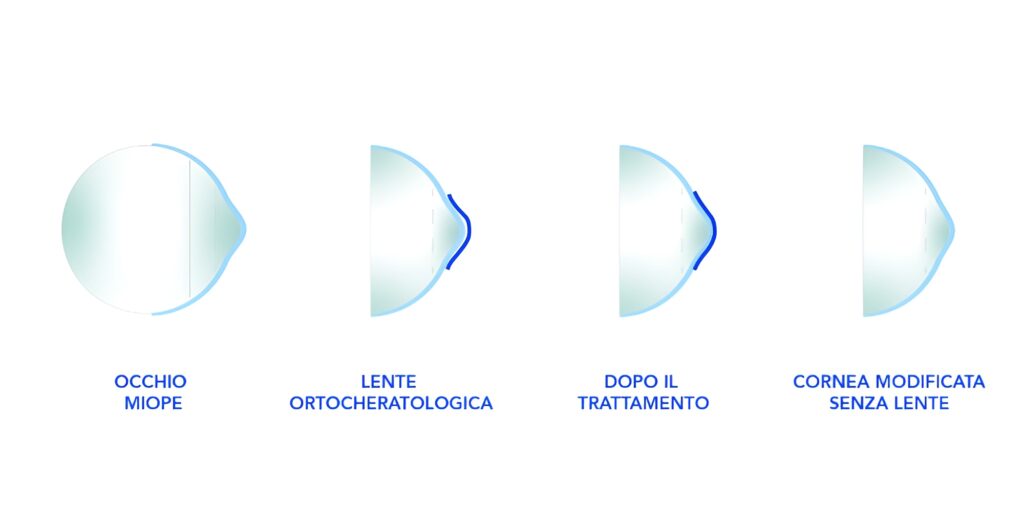 Ortocheratologia notturna